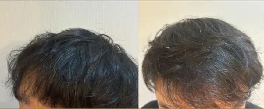 レバクリでの治療後の状態