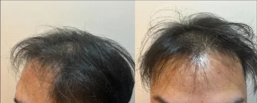 レバクリでの治療前の状態